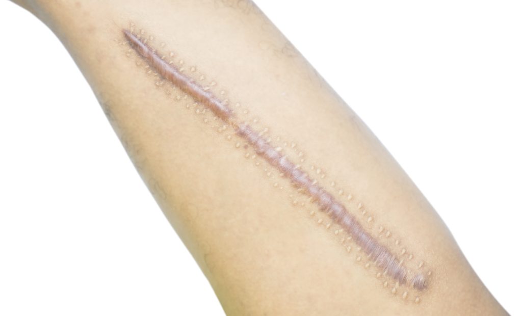 Scar Revision Treatment