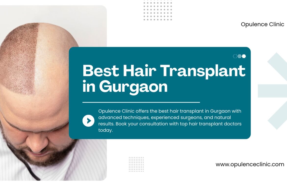 Best hair transplant in gurgaon